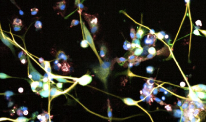 Nuclear cells when a patient had a GBM